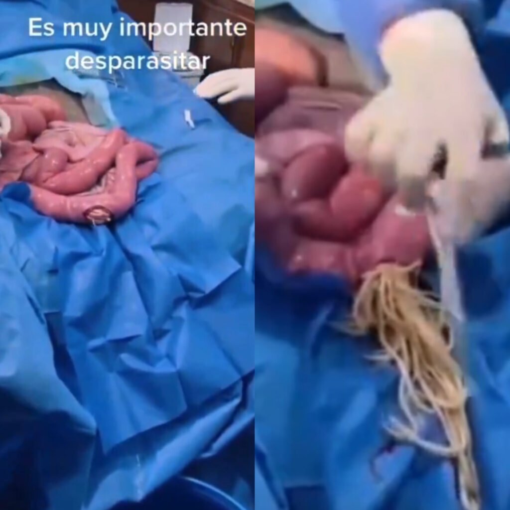 Deworming Video: Doctors Remove Hundreds Of Parasitic Worms From Human Intestine